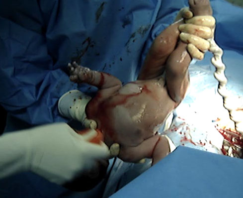 تبخال تناسلی زایمان طبیعی ، راههای انتقال ویروس تبخال به نوزاد ۲ - قلقلی خان تبخال تناسلی زایمان طبیعی ، راههای انتقال ویروس تبخال به نوزاد ۲ - قلقلی خان