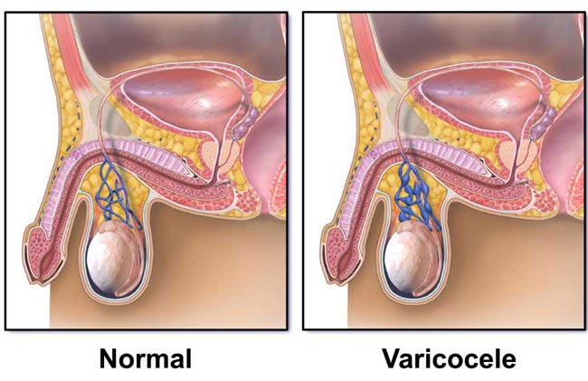 درمان واریکوسل در مردان ، انواع عمل جراحی واریکوسل - قلقلی خان