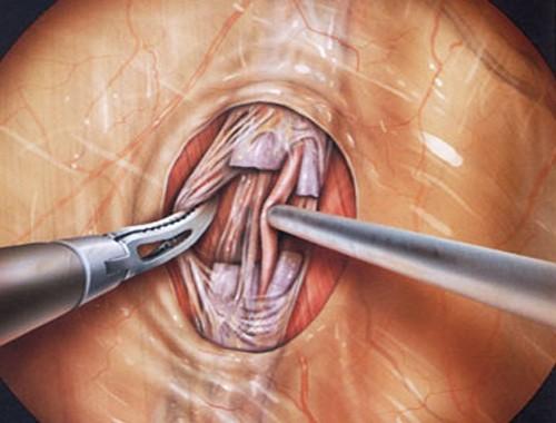 درمان واریکوسل در مردان ، عمل جراحی واریکوسلکتومی - قلقلی خان