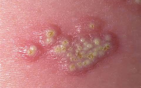 سوال و جواب درباره تبخال تناسلی، پرسش و پاسخ درباره تبخال تناسلی - قلقلی خان سوال و جواب درباره تبخال تناسلی، پرسش و پاسخ درباره تبخال تناسلی - قلقلی خان