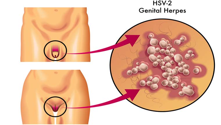 شکل ظاهری تبخال تناسلی در مردان و زنان - قلقلی خان
