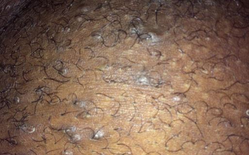 علت تبخال تناسلی در زنان و مردان، دلیل بوجود آمدن تبخال تناسلی - قلقلی خان علت تبخال تناسلی در زنان و مردان، دلیل بوجود آمدن تبخال تناسلی - قلقلی خان