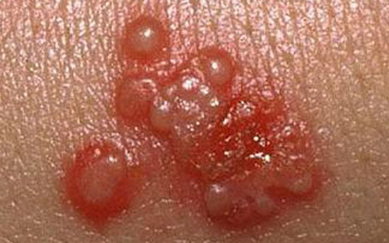 عوارض تبخال تناسلی در مردان و زنان، خطرات تبخال تناسلی - قلقلی خان عوارض تبخال تناسلی در مردان و زنان، خطرات تبخال تناسلی - قلقلی خان