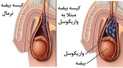 انواع واریکوسل در مردان ، درجه بندی واریکوسل بیضه - قلقلی خان