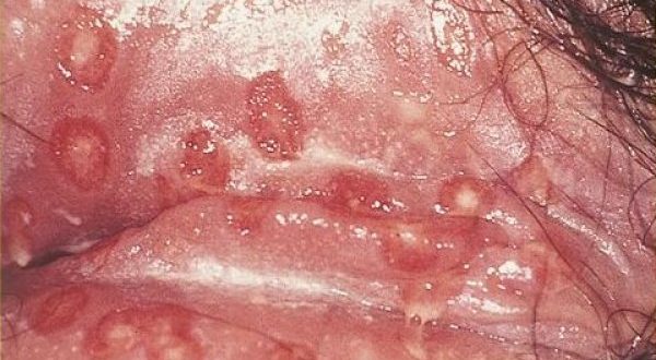 تبخال تناسلی در دوران بارداری ، تبخال تناسلی در زنان باردار ۲ - قلقلی خان