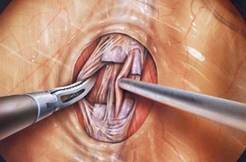 درمان واریکوسل در مردان ، عمل جراحی واریکوسلکتومی - قلقلی خان