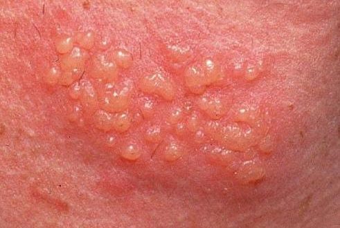 درمان گیاهی تبخال تناسلی مردان و زنان - قلقلی خان