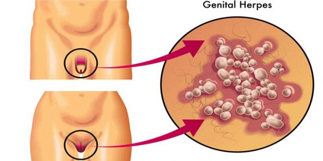 شکل ظاهری تبخال تناسلی در مردان و زنان - قلقلی خان