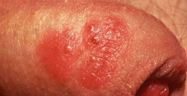 علائم تبخال تناسلی در مردان، نشانه های تبخال تناسلی در زنان - قلقلی خان