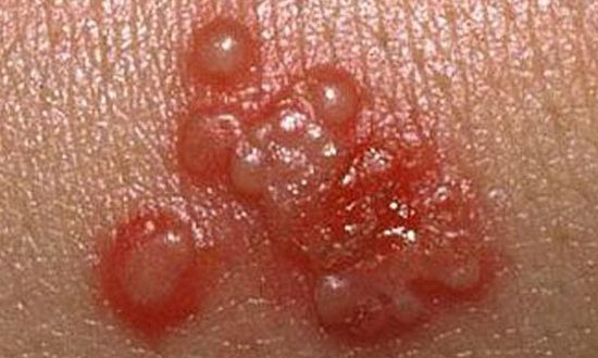 عوارض تبخال تناسلی در مردان و زنان، خطرات تبخال تناسلی - قلقلی خان